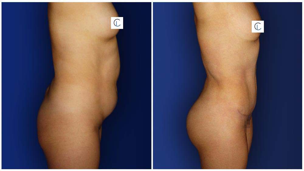 0-march-tummytuck-5